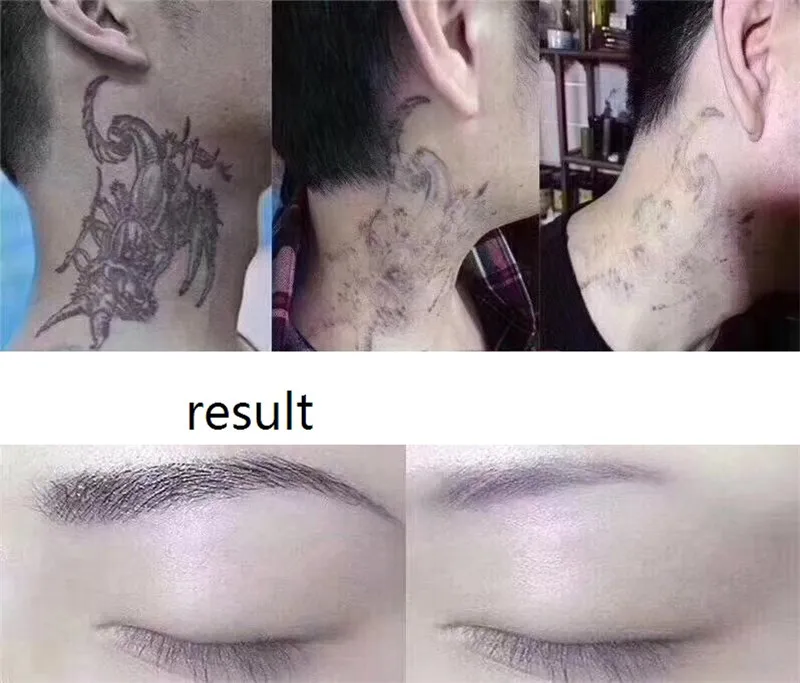 Boroline Tattoo Removal Cream Reviews