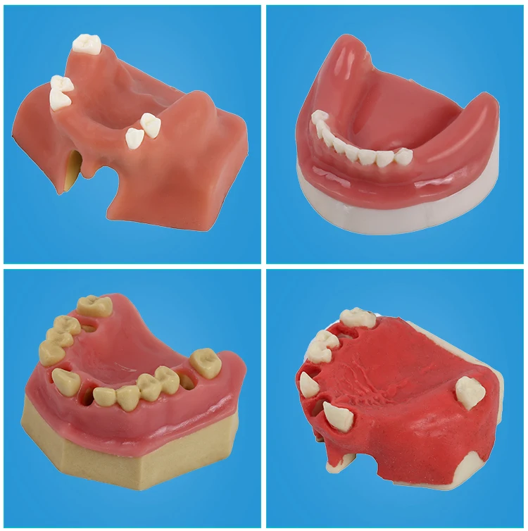 Стоматологические материалы модель орального имплантата хирургические maxillary sinus Стоматологические принадлежности оборудование инструменты мягкие десны