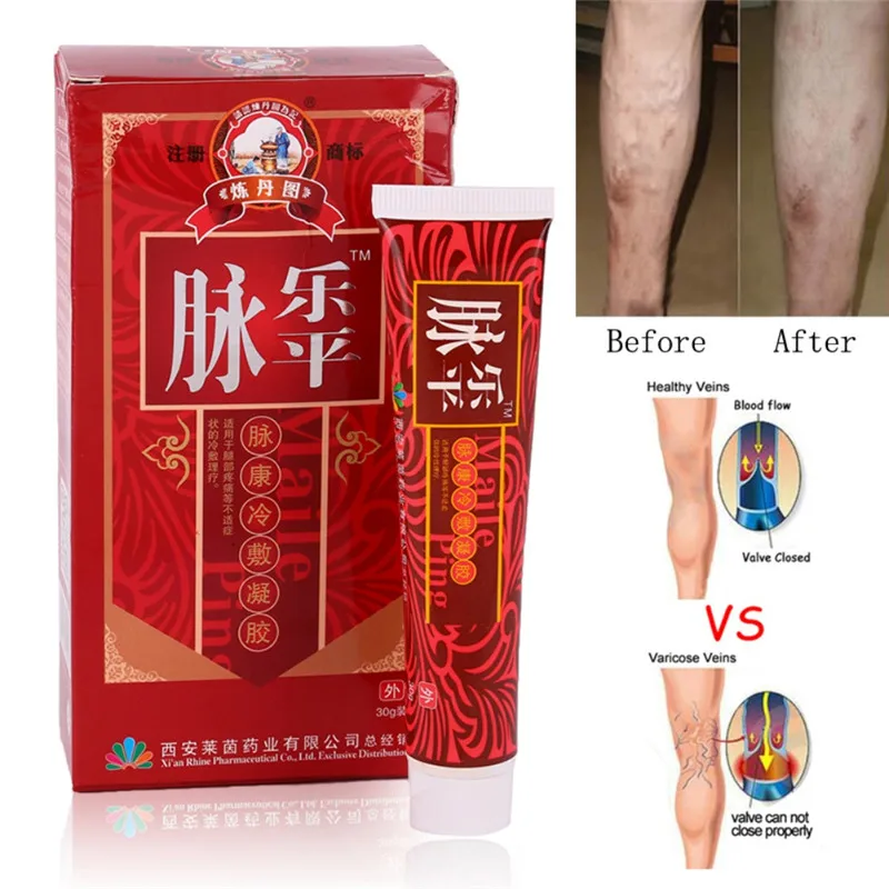 Varicose venas pies crema ungüento Vasculitis flebitis araña venas dolor Varicosity Angiitis reparación crema de eliminación