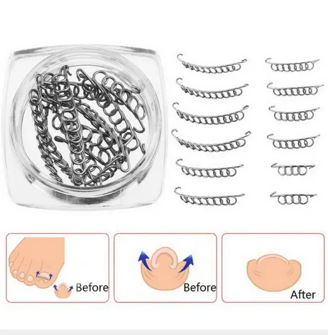 

1Box Ingrown Toe Nail Correction Lifter Wire Fixer Pedicure Paronychia Recover Toenails Corrector Foot Care Tool
