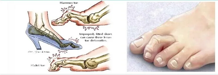 1 زوج للجنسين المطرقة سيليكون تو حماية العظام تو Ectropion مصحح منتجات الرعاية الصحية ملف للأقدام Valgus الضابط- 15