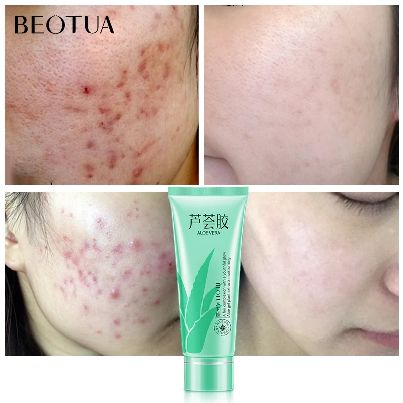 

BEOTUA Aloe Vera Gel Face Moisturizer Anti Wrinkle Cream Acne Scar Skin Whitening Skin Care Sunscreen Acne Treatment Cosmetics