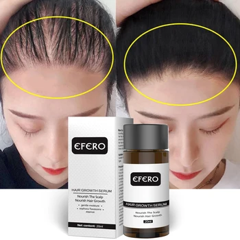 

EFERO Hair Growth Essence Preventing Hair Loss Dense Hair Fast Hair Growth Essence Serum Essential Oil Hair Care Product for Men