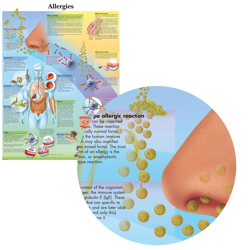 WANGART Анатомия человека аллергия диаграмма Арт плакат печать тела карта холст настенные картины для медицинского образования офис Домашний декор
