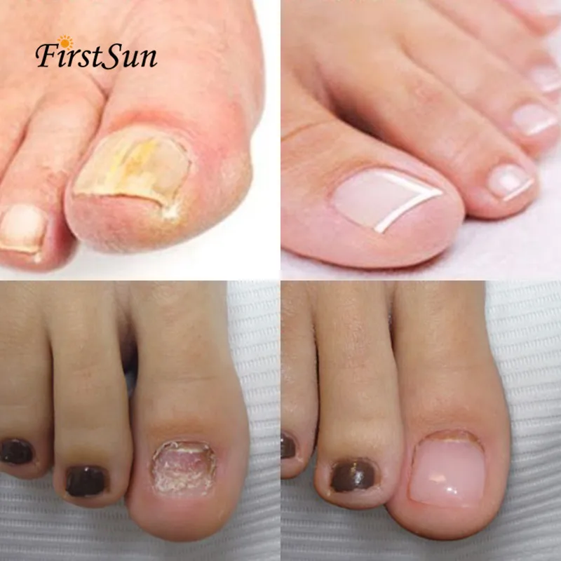 Herbal Antibacterial Nail Treatments Kit Essential Oil Herbal Extract Fungus Art nail Repair Foot Nail Care Improve Infection