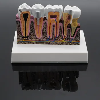 

Caries Demonstration Anatomical Teeth Common Pathologies Model Dental Detachable