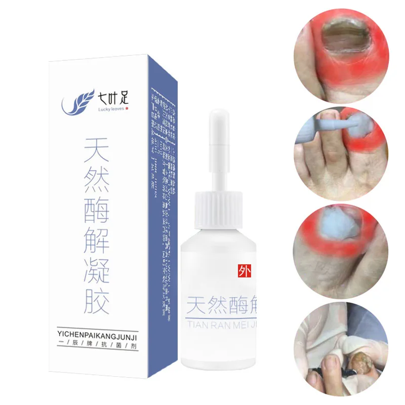 Limited Chance for  Dropshipping 5ml Nail Treatment Liquid Effective Paronychia Fungus Infection Repair Solution Gel SM