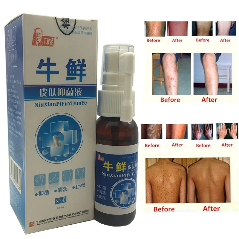 Облегчение кожи Probelm мазь спрей Комбинация Китайский продукт кожи неудобный продукт