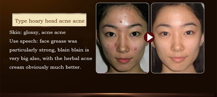 Австралия Чай дерево лечебные гель для лица Acne крем для сухой кожи, акне кожи лекарств лечение акне уход за кожей для угрей