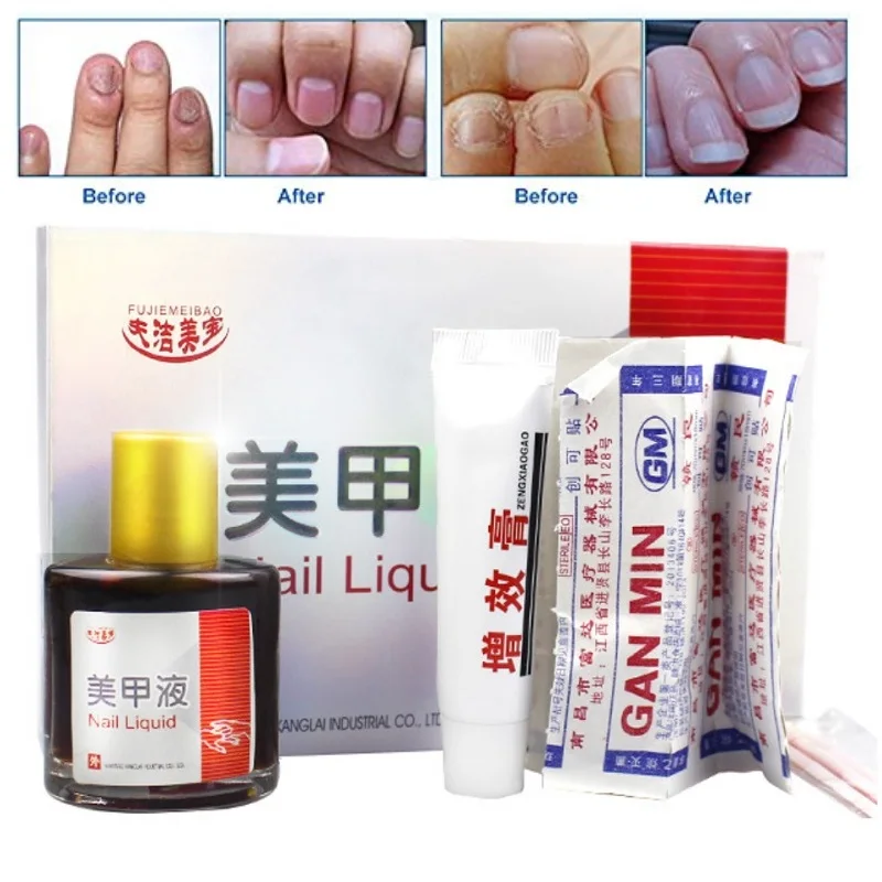 Toe Nail Fungus Treatment Of Chinese Medicine Herbs Anti Fungal Infection Essence Nail Treatment Removal Nail Care Lotion