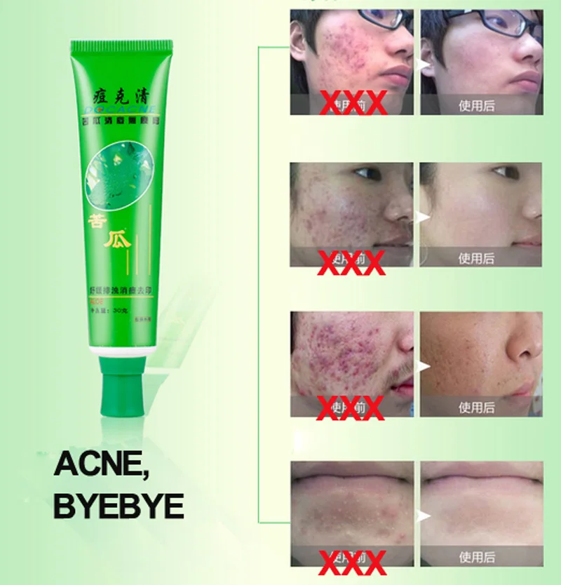 OEM-Acne-Removing-and-Anti-Acne-Cream