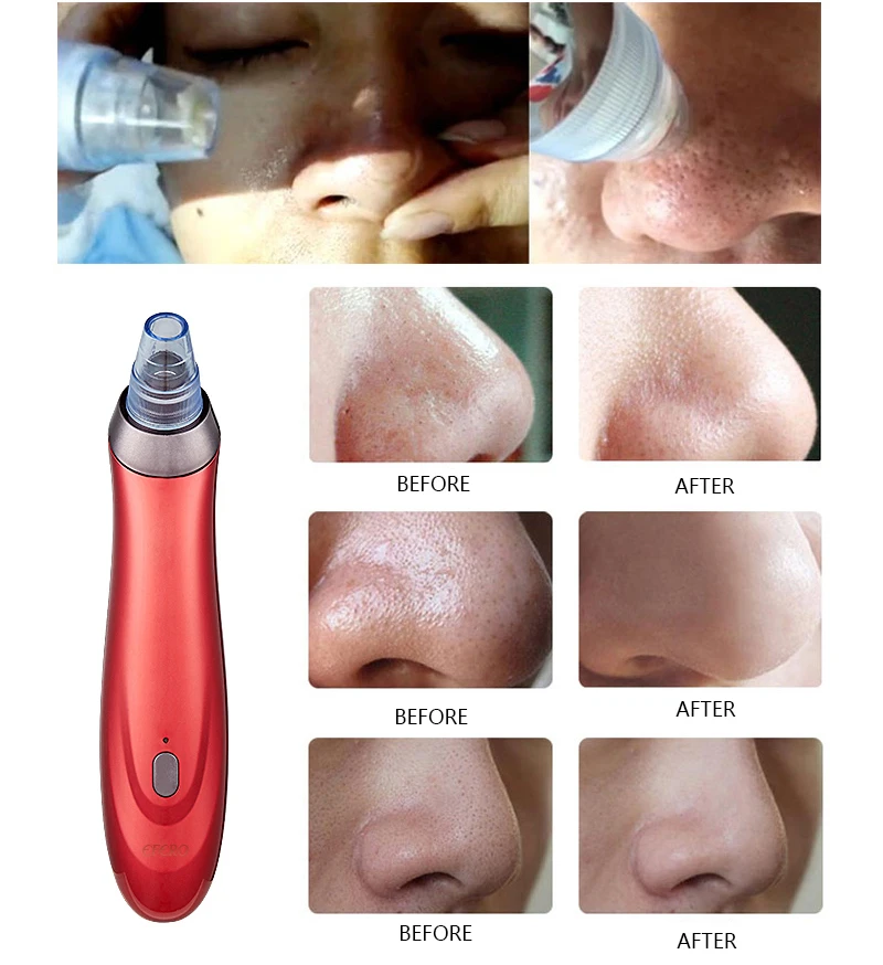 

Blackhead Remover Vacuum Pore Cleaner Acne Pimple Removal Tool for Face Cleaning Machine Skin Care Deep Cleansing Face Cleaner