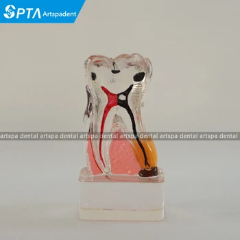 

Dental Teeth Model 4 Times Periodontal Disease Assort Tooth Classification Model