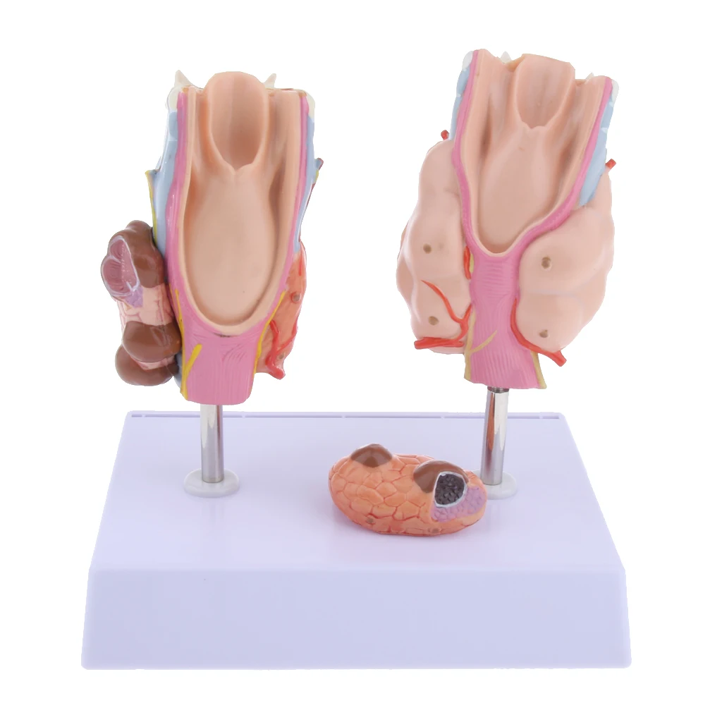 

Magnified Human Thyroid Diseased Anatomy Model Teaching Supplies