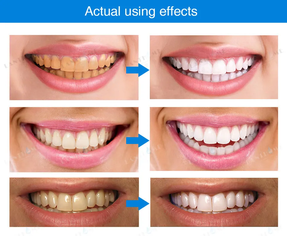 Lanthome 3D отбеливание зубов ручка отбеливание гель Отбеливание, удаление пятен гигиена полости рта мгновенная улыбка Pro нано отбеливание зубов комплект