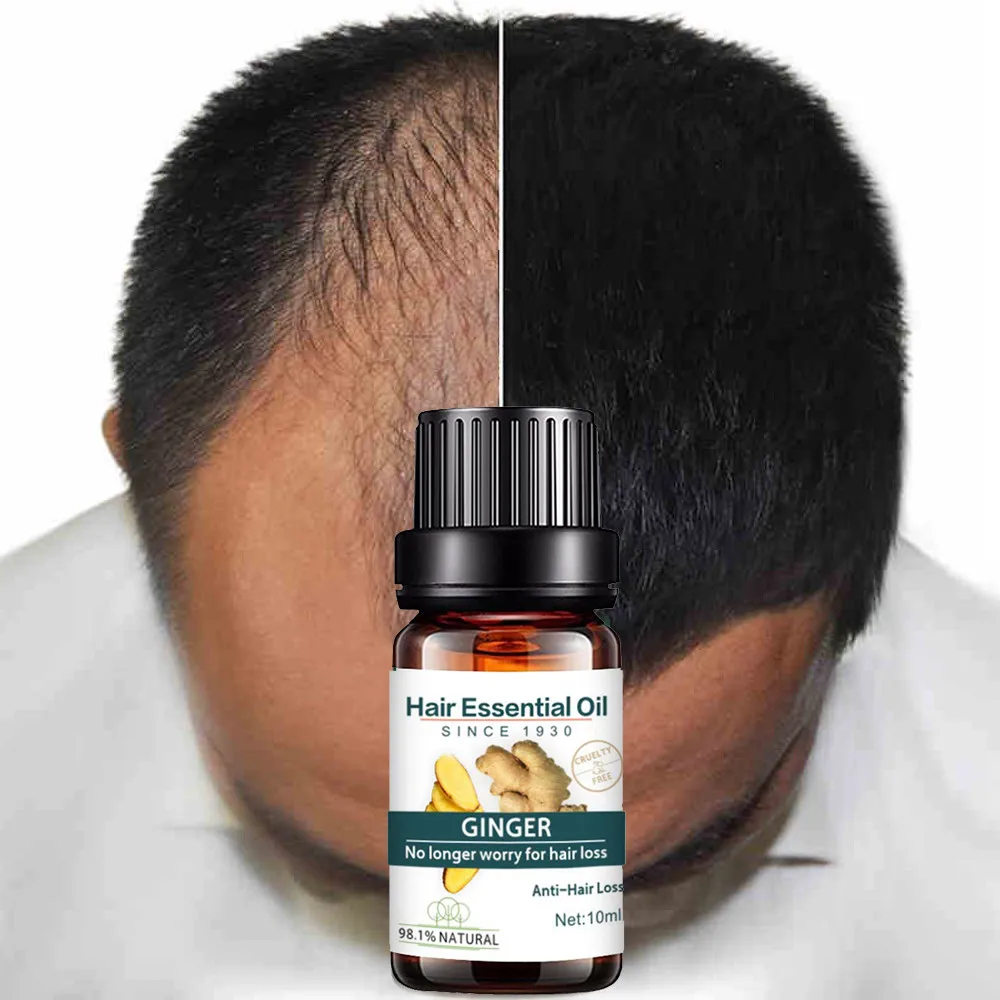 Средство от облысения. Домашнее средство от облысения. Маска от залысин для женщин. Домашнее средство от облысения. Домашнее средство от облысения.