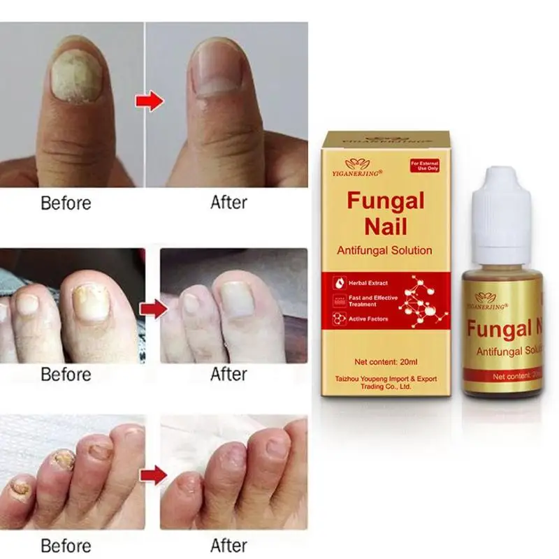 

20ml Nail Suppressive Fluid Nail Cuticle Oil Fungal Nail Nutrition Revitalizer Oil Softener Repair Nail Skin Protector Treatment