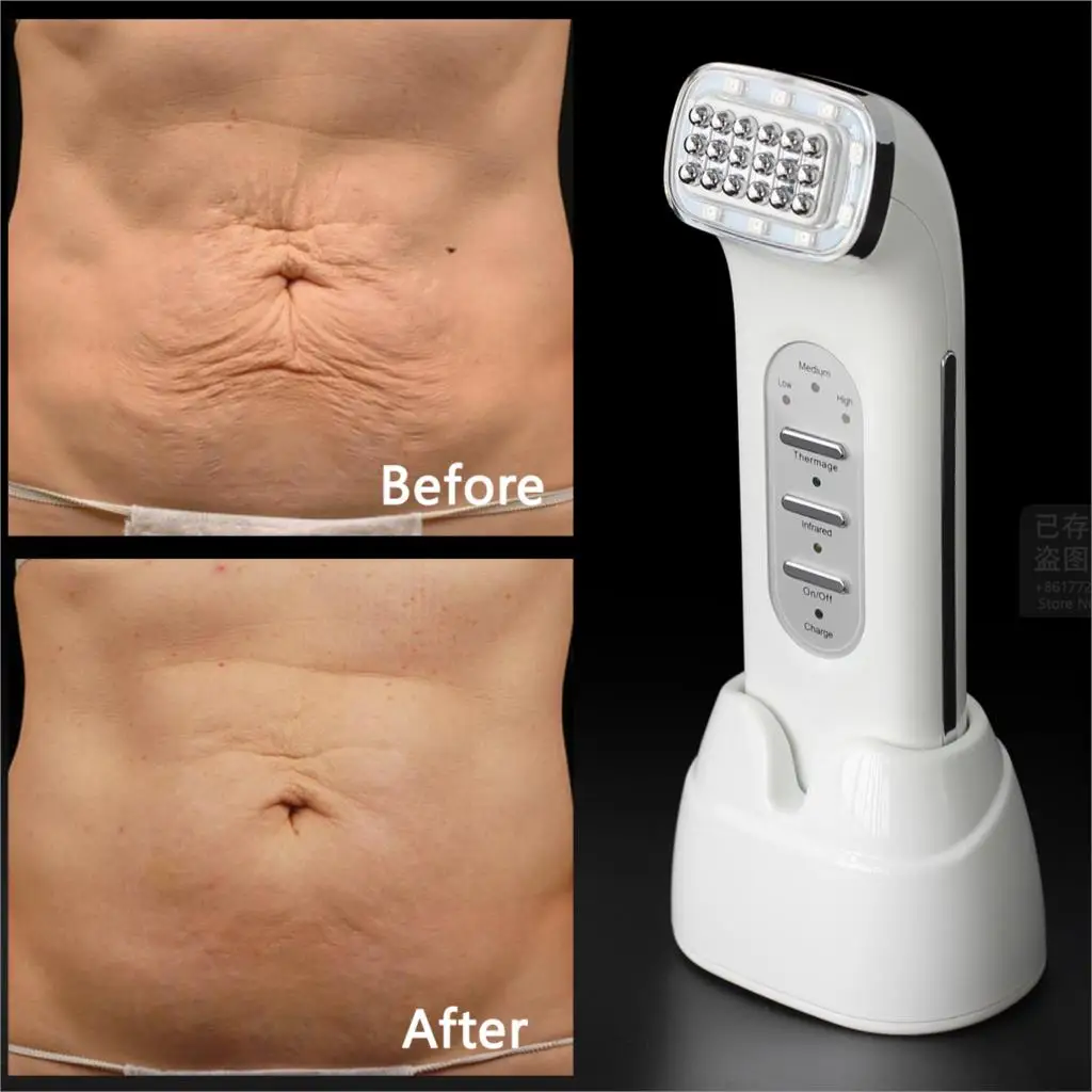 Beauty Star RF лифтинг кожи удаление морщин Красота машина точечная матрица лица радиочастотная подтяжка лица подтяжка кожи