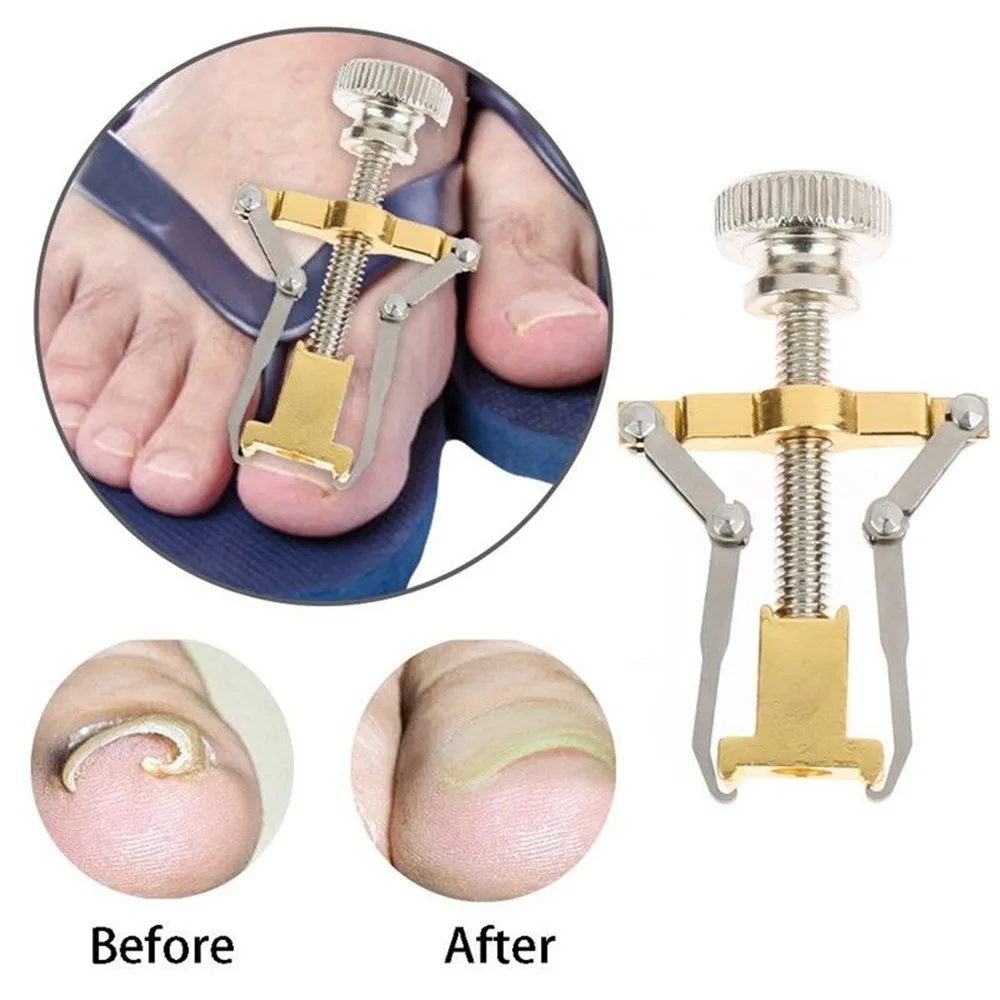 Для вросших ногтей, педикюра Уход за ногтями на ногах инструменты для нейл-арта для ног ортопедический акроникс от вросших ноготей onyxis корректор шишки на большом пальце для пальцев ног