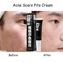 Acne Scars Pit Cream lightening anti acne cream to remove dark spots Vitamin e capillary cream rejuvenation facial serum retinol
