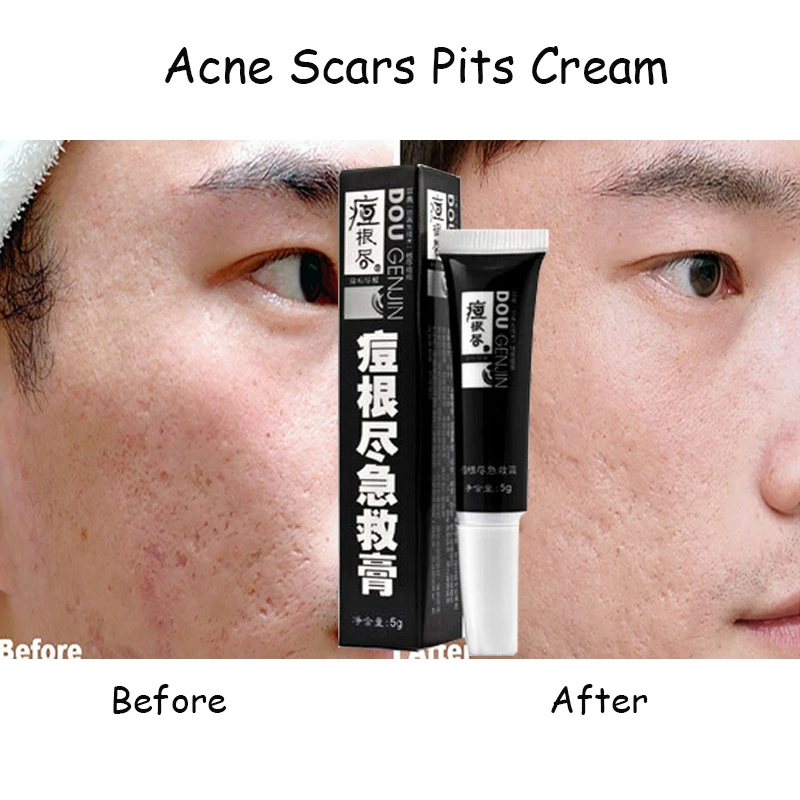 vitamin a cream for scars