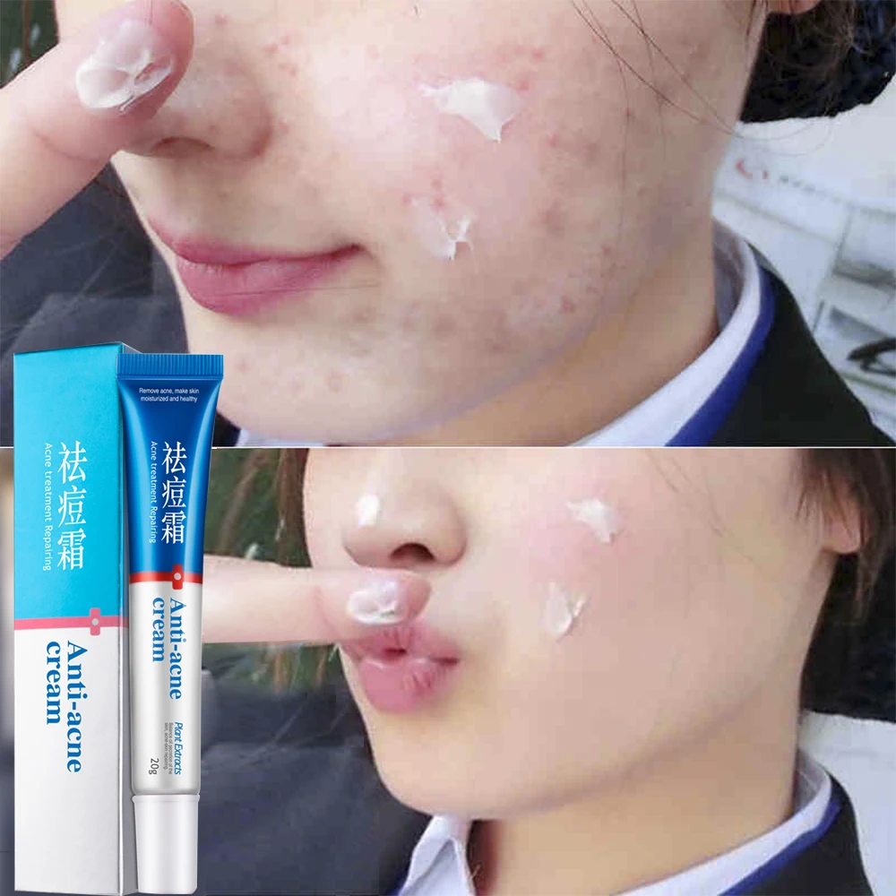 

Acne Cleaning Cream Blackhead Care Remove Repair Comedone Pimple Acne Quickly Face Acne Cream Remover Anti Acne#