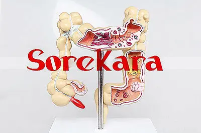 

Human Anatomical Colon Polyp Cancer Ulcer Diseased Organ Medical Teach Model School Hospital