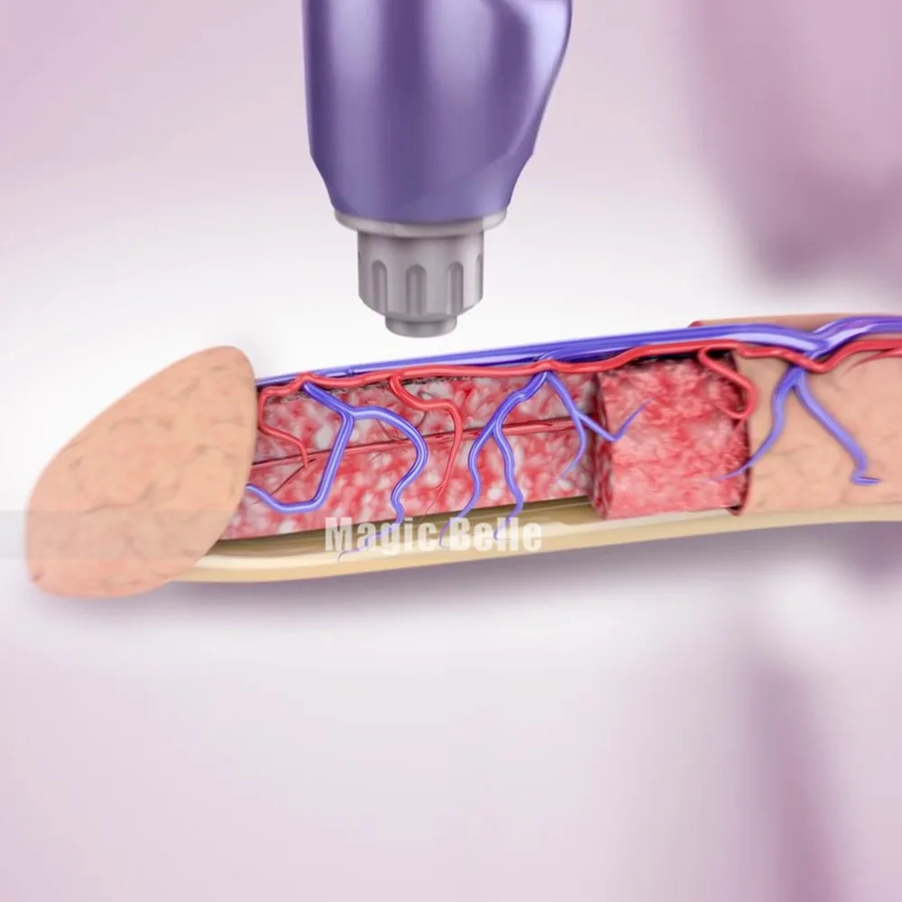 Новейшая технология eswt машина для ударно-волновой терапии умная волна шоковая волна терапия машина Лечение эрекции дисфункции