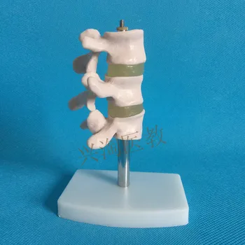 

typical Spine lesion model skeleton model spinal pathological anatomical model