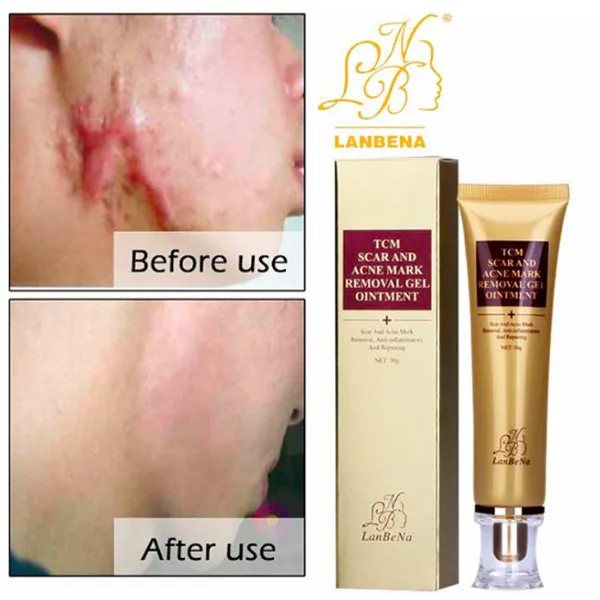 30ml LANBENA ginseng extract against black dots cream scar removal facial blackhead acne skin