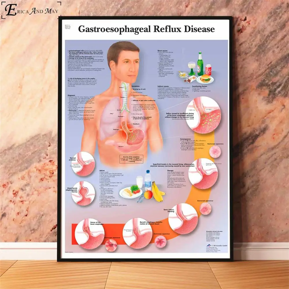 Анатомия болезни патологии диаграмма картина, печатный плакат декоративные настенные картины для комнаты без рамки украшения дома аксессуары - Цвет: Gastroesophageal