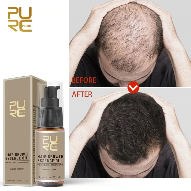 

PURC New 1pcs Fast Hair Growth Essence Oil Hair Loss Treatment Help for Hairs Growth Hairs Care 20ml High Quality