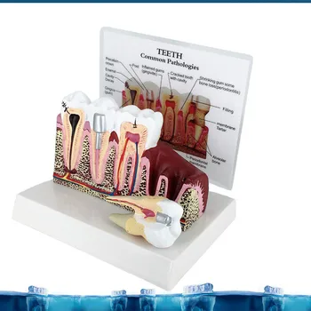 

2X Large Dental Teeth Common Pathologies Model Anatomy Skull Skeleton Anatomical Brain Model Mixer In Trauma Esqueleto Anatomia
