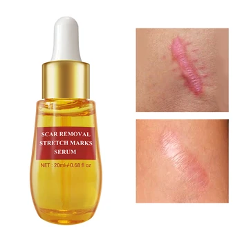 Professional Make Up  20ml Acne Scar Remove Serum Acne Treatment Remover Stretch Marks Anti Acne Hot Sale