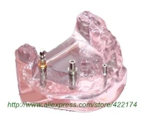 Имплантата модель для обучения зубной зуб зубы Стоматологическая анатомическая Стоматологическая модель