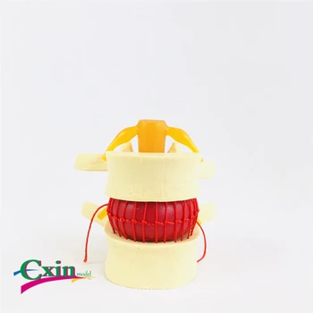

Human yellow lumbar intervertebral disc demonstration model Lumbar vertebrae anatomy Medical teaching