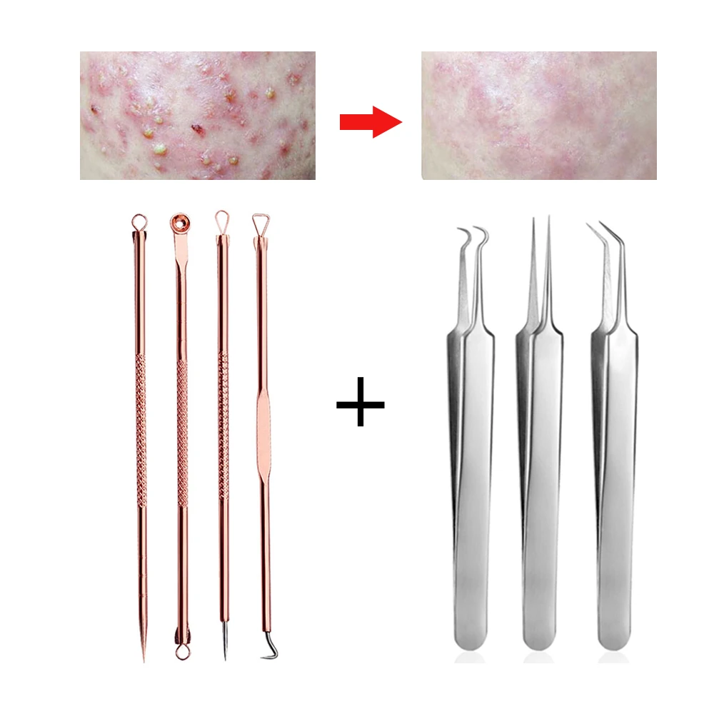 spalife blackhead extractor tool spalife blackhead extractor tool