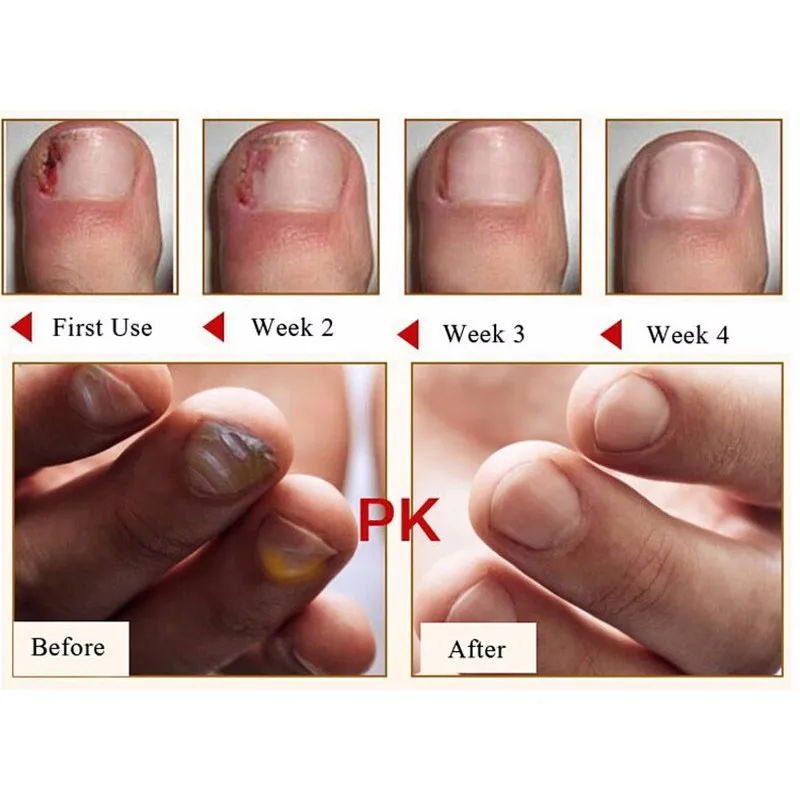 Natural Nail Protector Skin Care Cream Nail Fungus Treatment Herb Antifungal Cream 15g