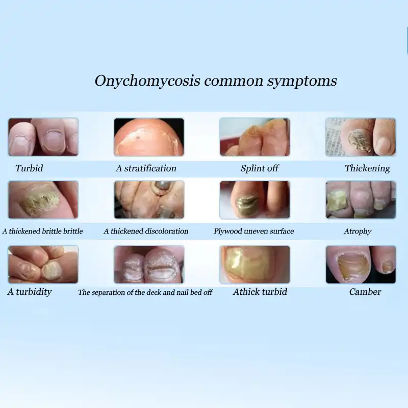 best antifungal nail treatment best antifungal nail treatment