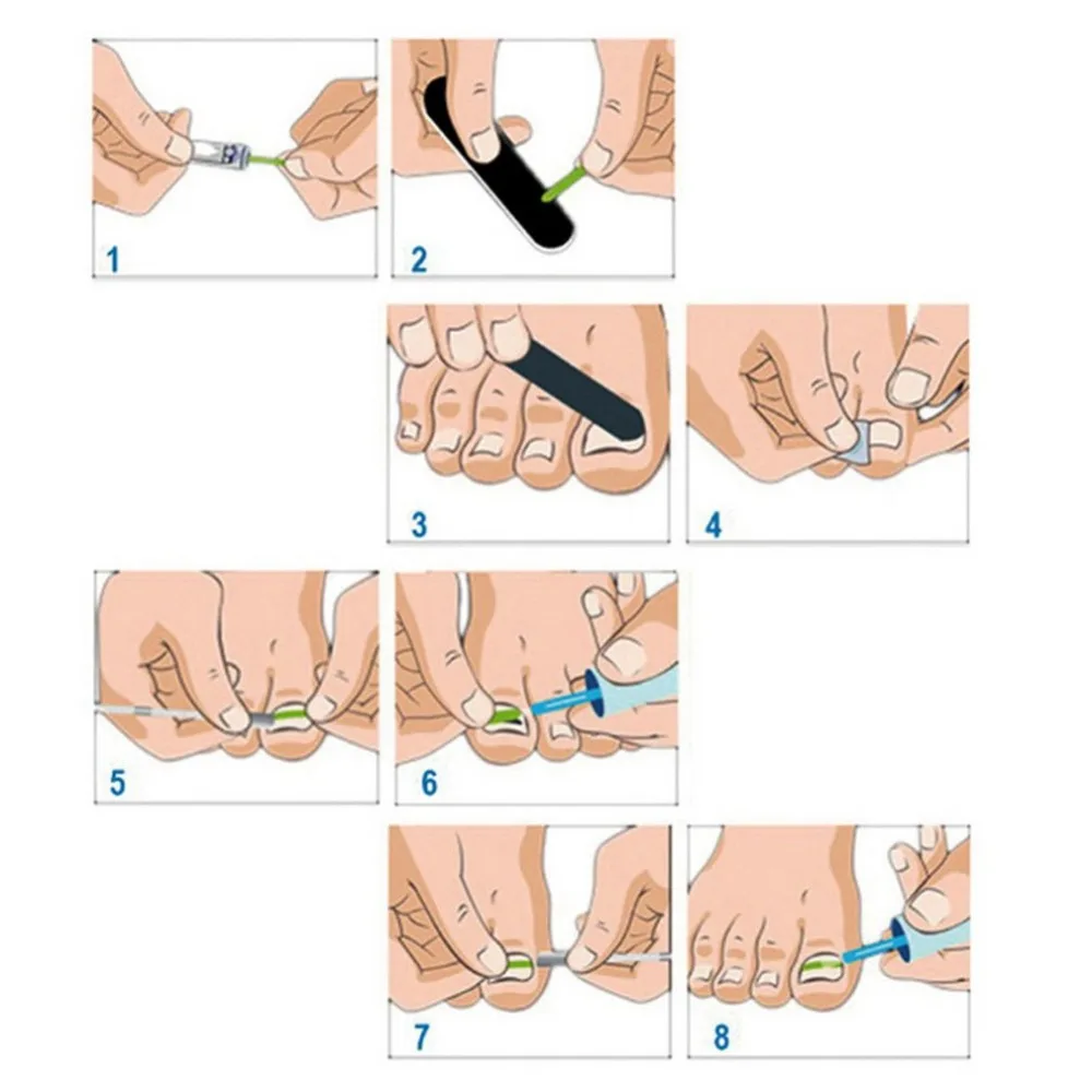 Вросшие ногти выпрямление клип изогнутые BS Brace патч толстые Paronychia коррекции Tool Kit Toenail атлет инструмент для лечения вросшего ногтя