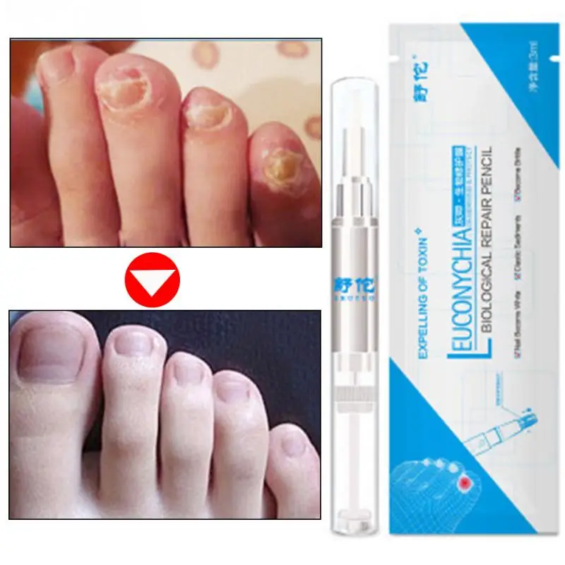 3ml Fungus Nail Treatment Serum Anti Fungal Hand Foot Care Nail