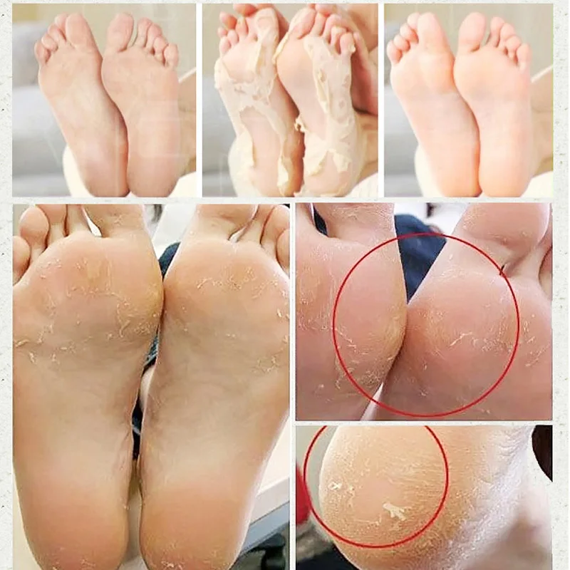 

Baby Foot Peeling Renewal Exfoliating Foot Mask Socks Renewal Dead Skin Remove Dead Skin Remove Foot Skin Care Sock for Pedicure