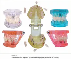 1 шт. зубной имплантат заболеваний зубов Модель с восстановлением мост зуб Стоматолог для медицинские стоматолога подготовки и обучения