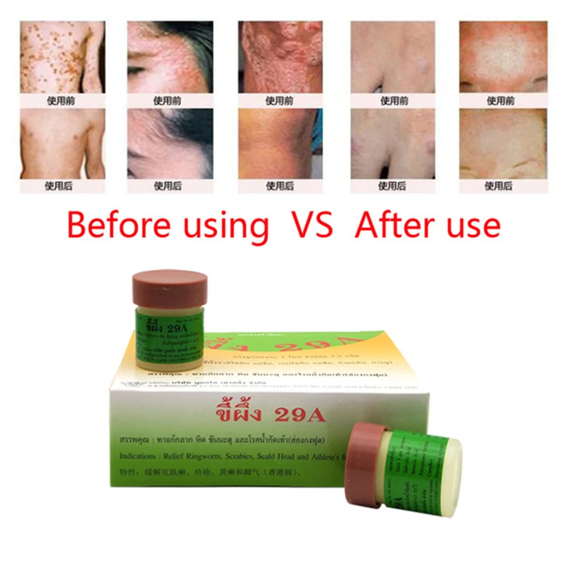 

24PCS Natural Cream Works Really Well For Psoriasi Eczma 29A