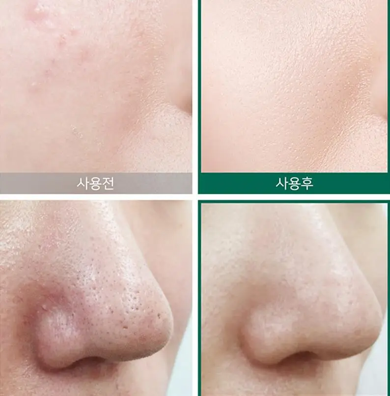 Некоторые MI ана BHA ПГА 30 дней чудо крем + эссенция Уход за лицом угрей лечение для