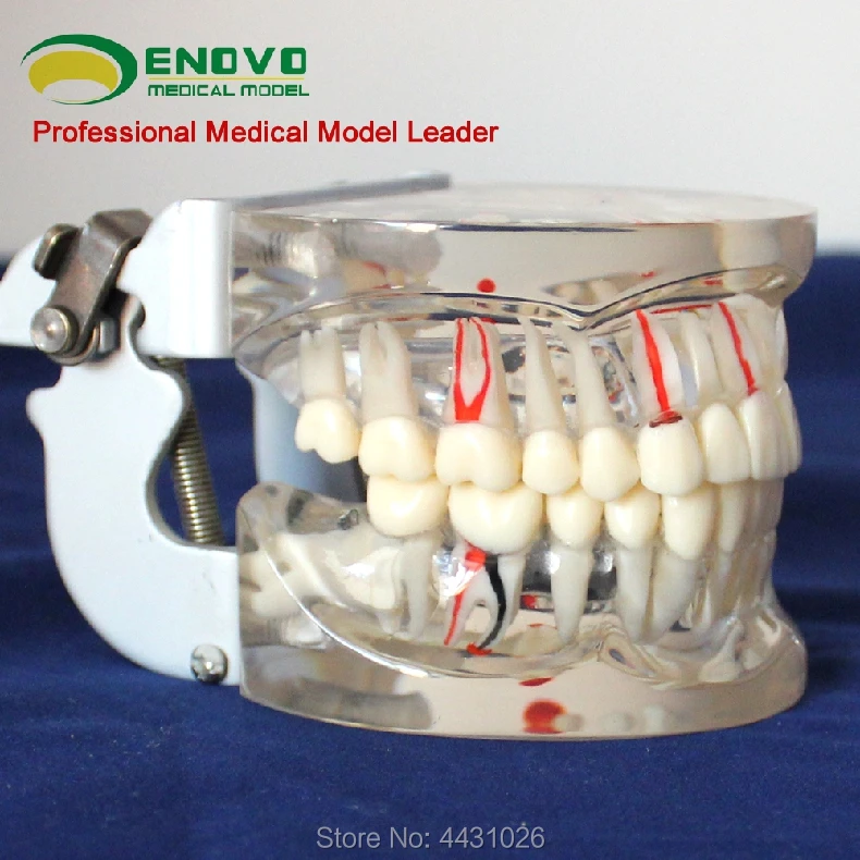 ENOVO A demonstration model of dental caries for dental model of dental model with transparent adult comprehensive oral patholog ENOVO A demonstration model of dental caries for dental model of dental model with transparent adult comprehensive oral patholog
