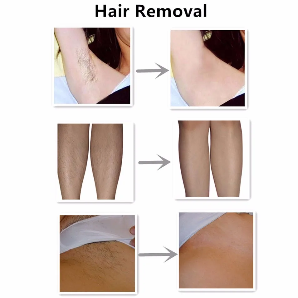 HAIR REMOVAL