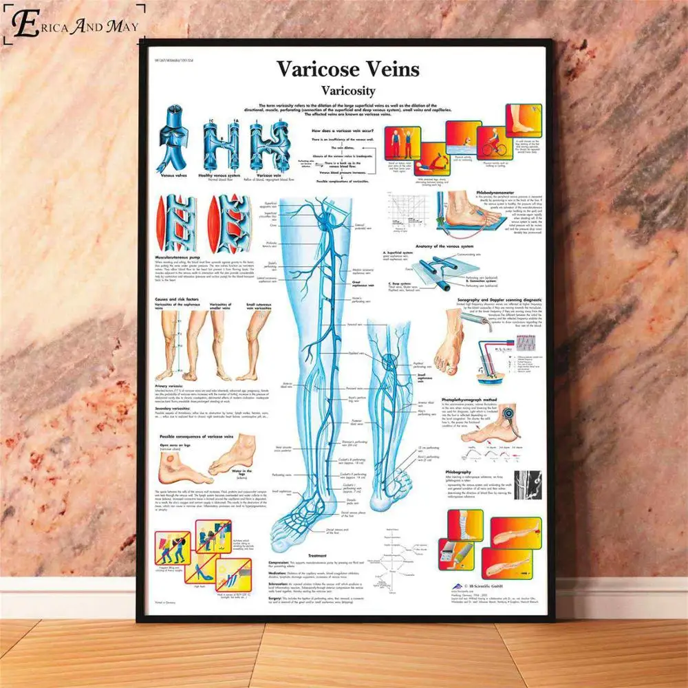 Анатомия болезни патологии диаграмма картина, печатный плакат декоративные настенные картины для комнаты без рамки украшения дома аксессуары - Цвет: Varicose Veins