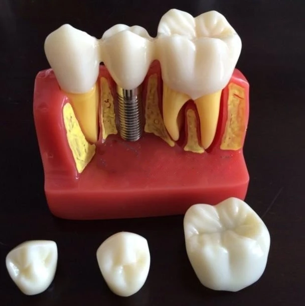 

High Quality Dentist Implant Disease Analysis Model Crown Bridge Demonstration Dental Model
