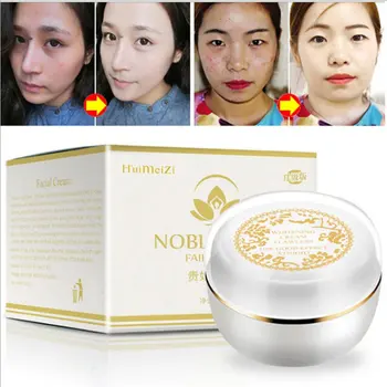 

Effective Sunburn Plaques Of Pregnancy Remove Face Brighten Magic Glow Freckle Removal Whitening Cream Skin Cream